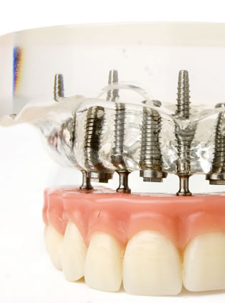 implant supported dentures